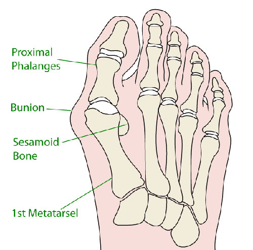 Bunion