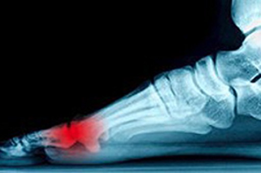 Understanding Sesamoiditis and Arthroscopic Relief