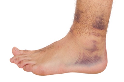 Grading of Ankle Sprains