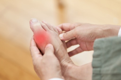 Everything You Need to Know About Gout