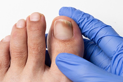 Toenail Fungus