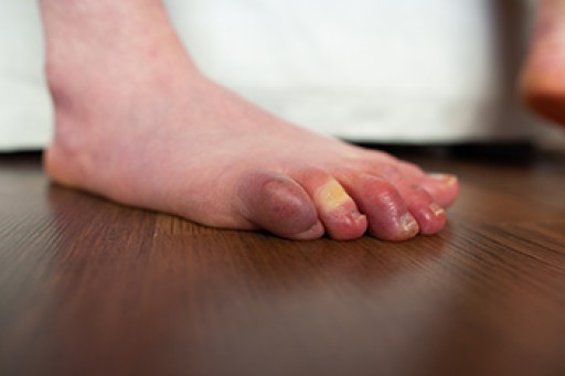 Rare Foot Conditions
