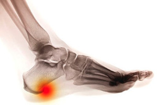 How to Treat Heel Spurs