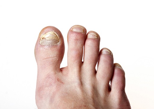 Avoiding Toenail Fungus