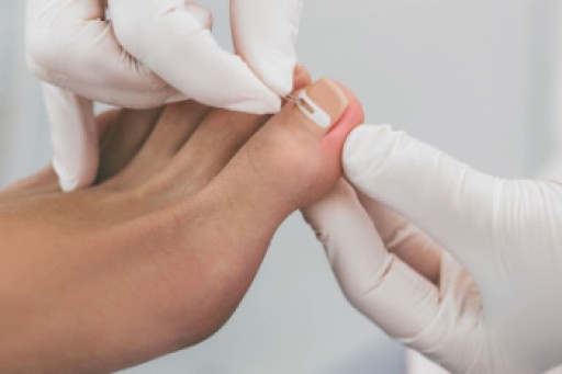 Facts About Ingrown Toenail Surgery