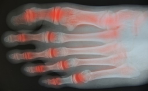 Rheumatoid Arthritis in the Feet
