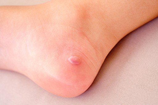 Why Did I Get a Foot Blister?