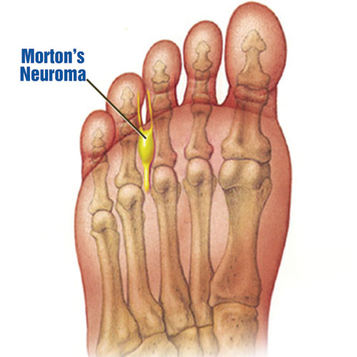 Neuroma