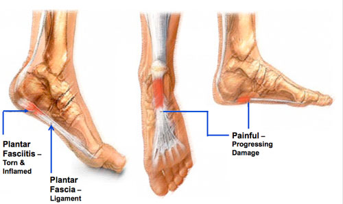 plantar fasciitis